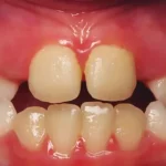 Crossbite Causes and Symptoms
