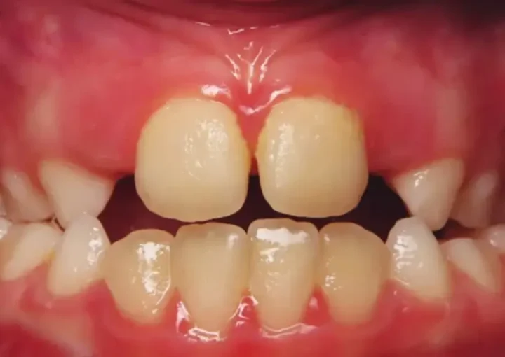 From Crossbite to Confident- The Journey to Perfect Smile 1 Crossbite