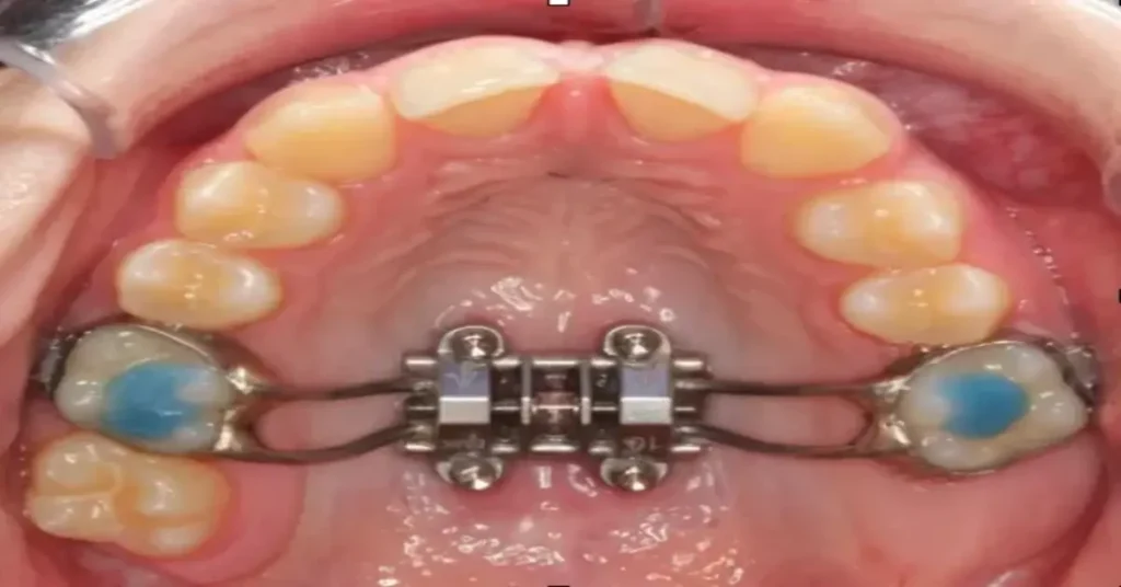 Orthodontic Expander