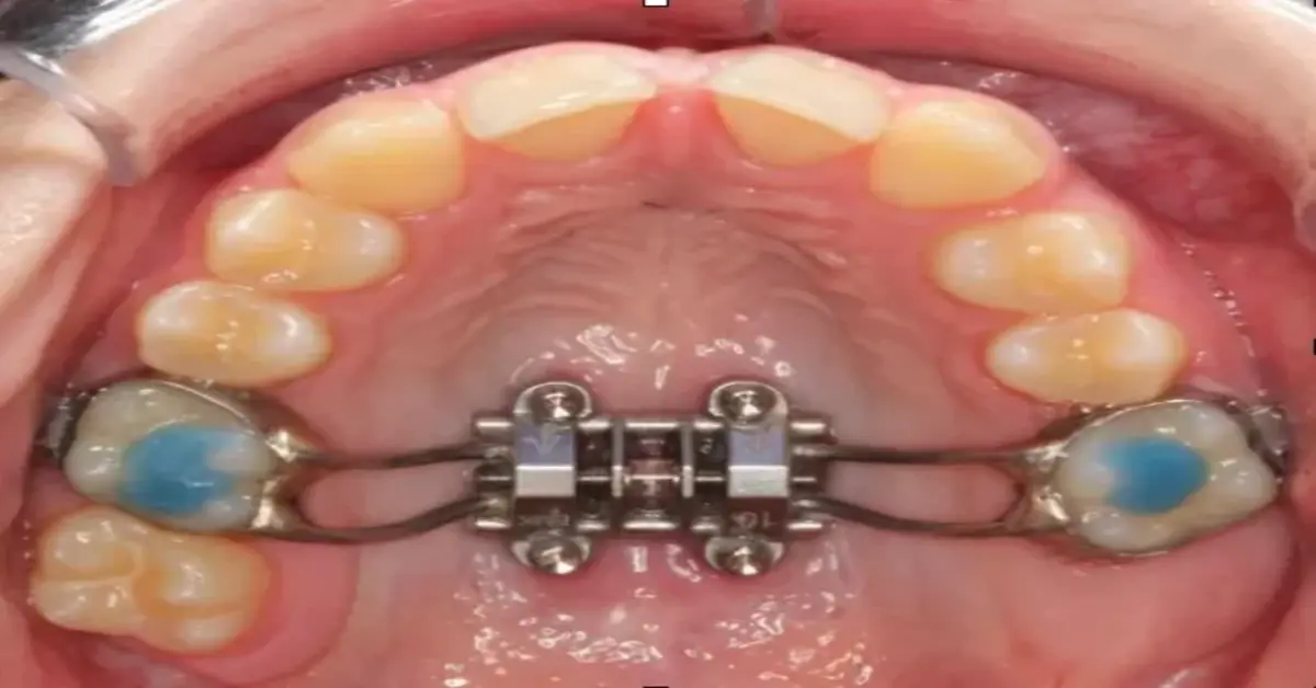 Orthodontic Expander