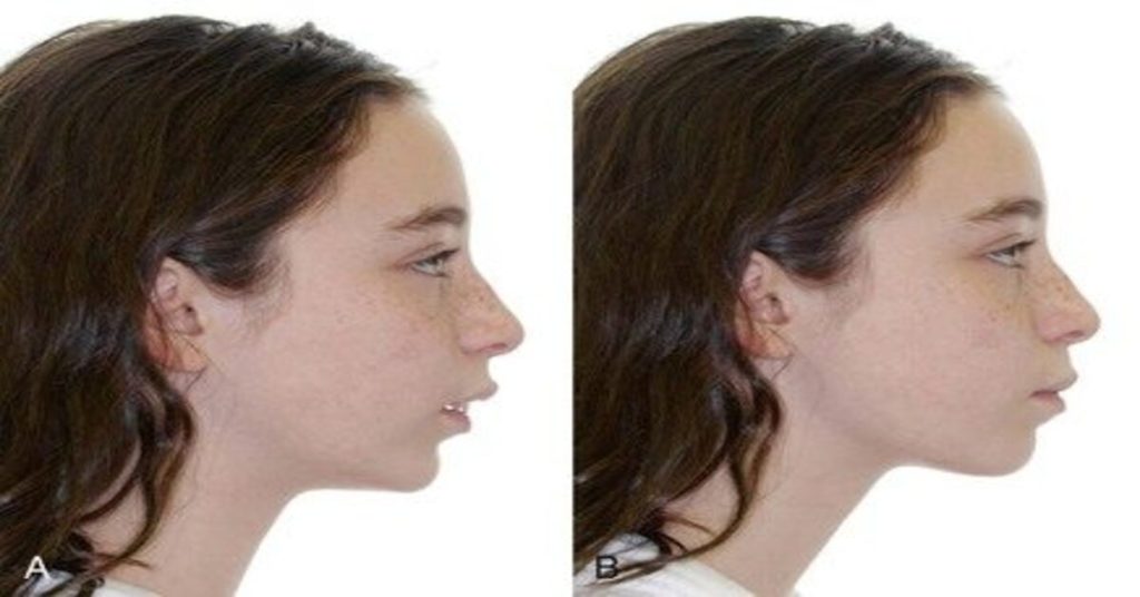 Orthodontic Treatment