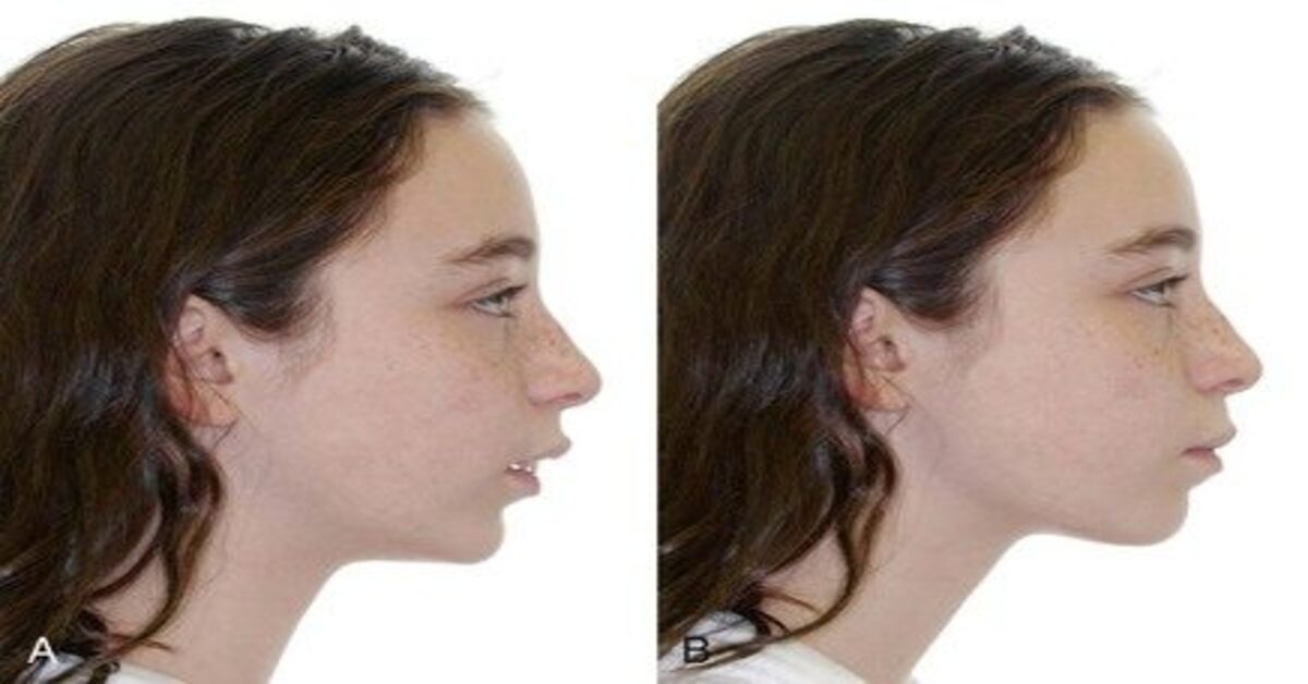 Orthodontic Treatment