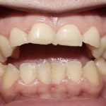 Open Bite Causes and Treatment