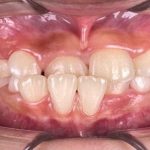 Underbite