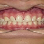 Dental Spacing
