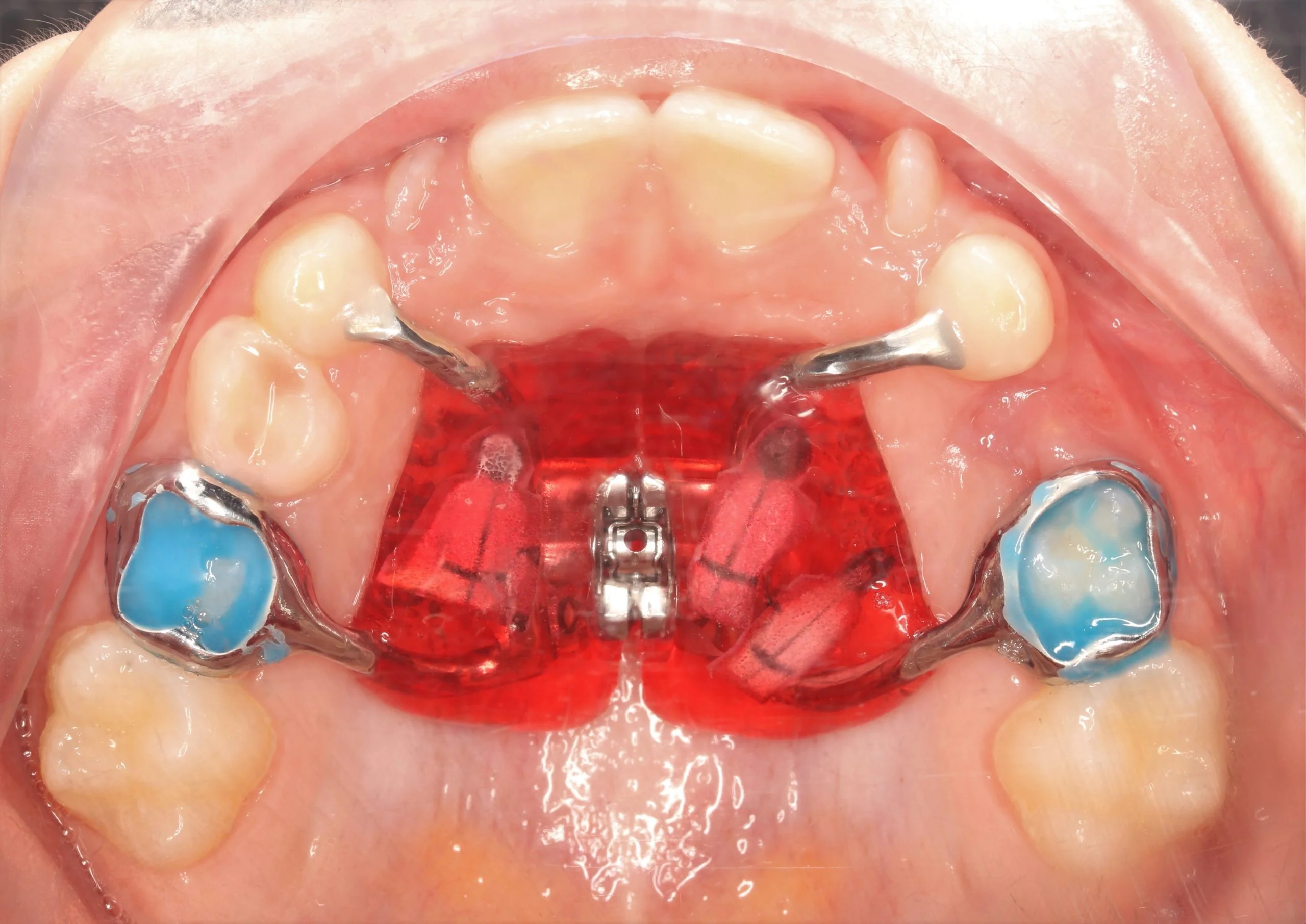 orthodontic expander
