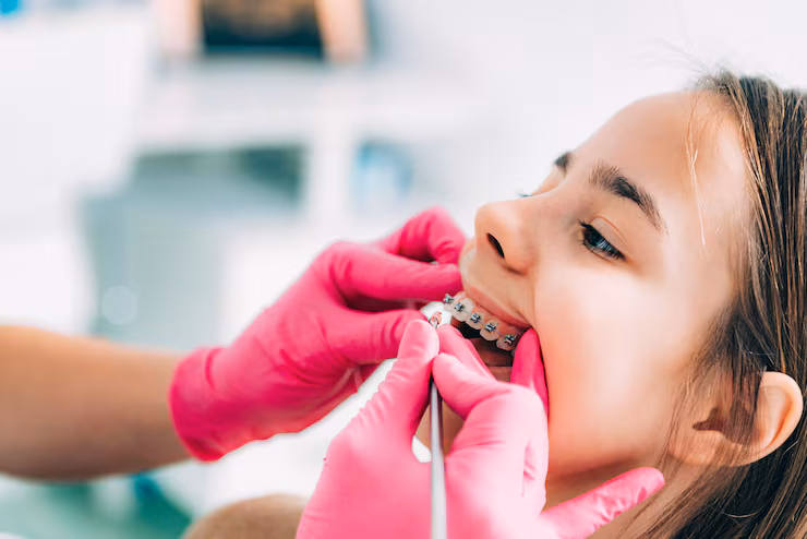 Palatal Expander for Kids in Jumeirah Dubai