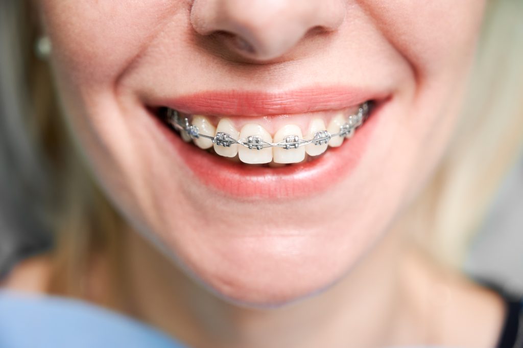 How long does Orthodontic treatment takes?