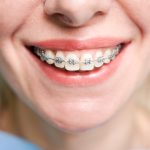 How long does Orthodontic treatment takes?