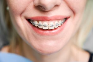 How long does Orthodontic treatment takes?