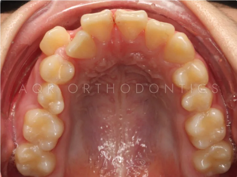Before Clear Aligners — Case 1