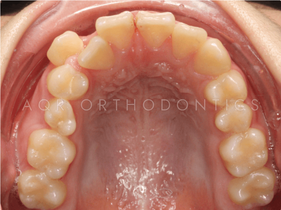 Before Clear Aligners — Case 1