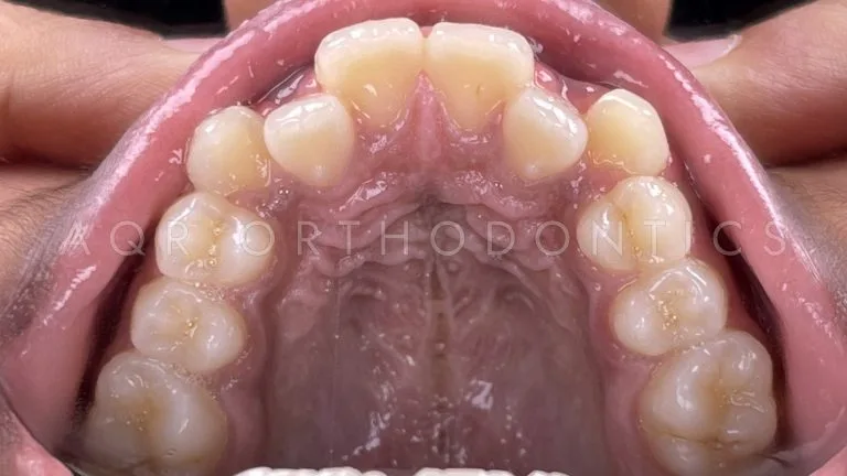 Before Braces — Case 1