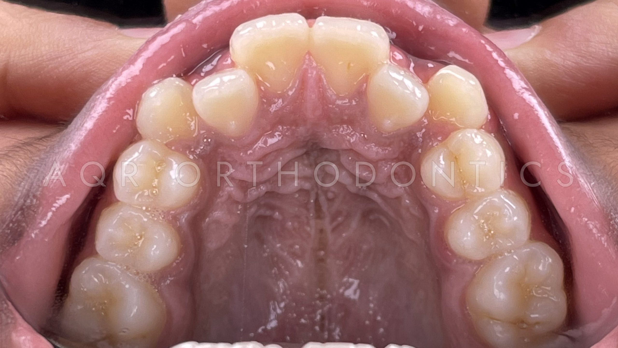 Before Braces — Case 1