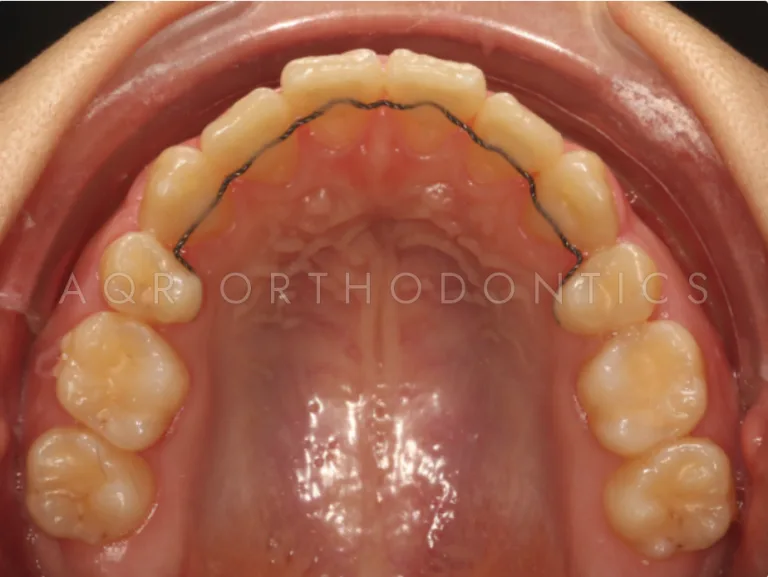 After Clear Aligners — Case 1