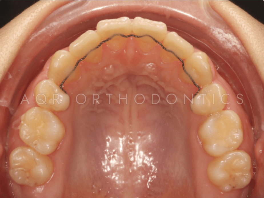 After Clear Aligners — Case 1