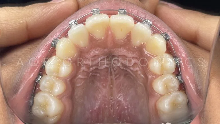 After Braces — Case 1