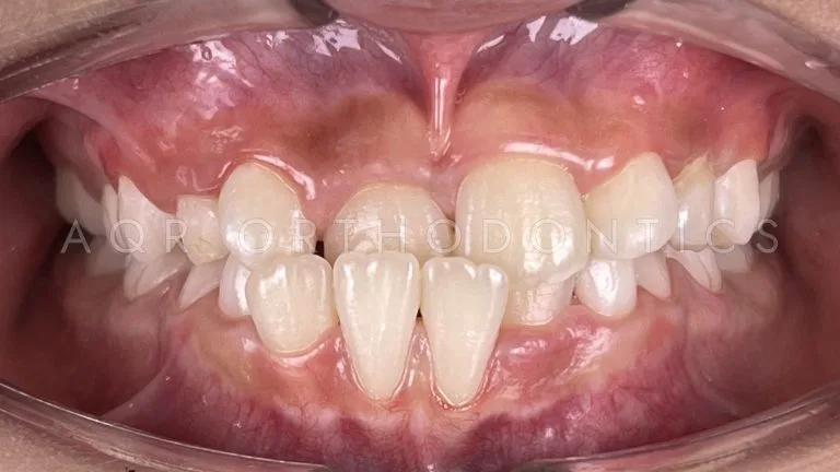 Before Braces — Case 2