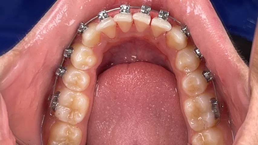 Damon Braces Dubai 