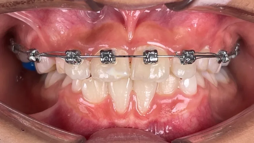 Spark Aligners Dubai