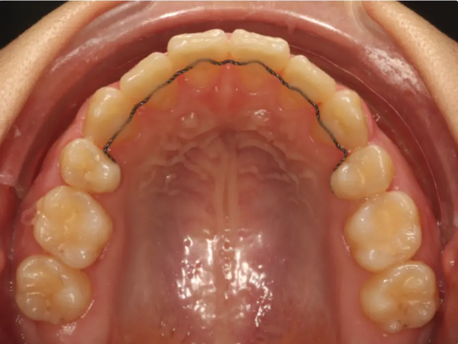 Clear aligners result — deep overbite corrected